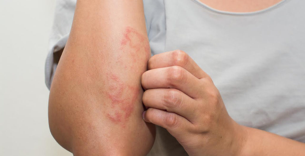 How to get rid of Dyshidrotic Eczema