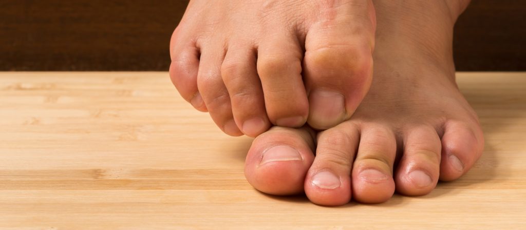 Is Bunion Surgery for Me?