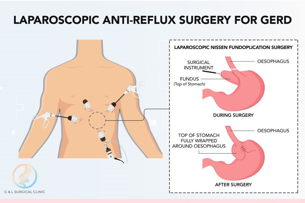 Acid Reflux in Singapore: Can it be cured?