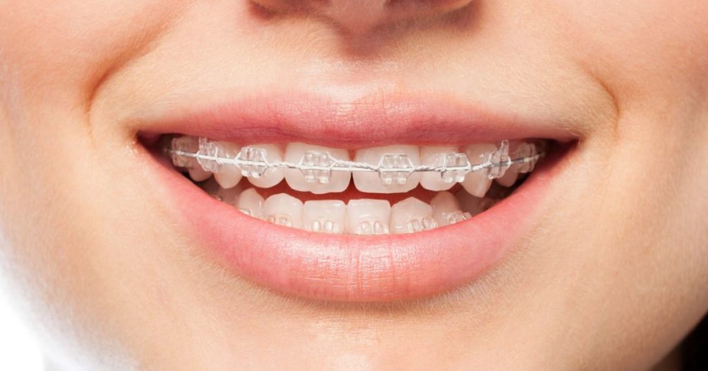 Orthodontic Treatment and What it’s All About