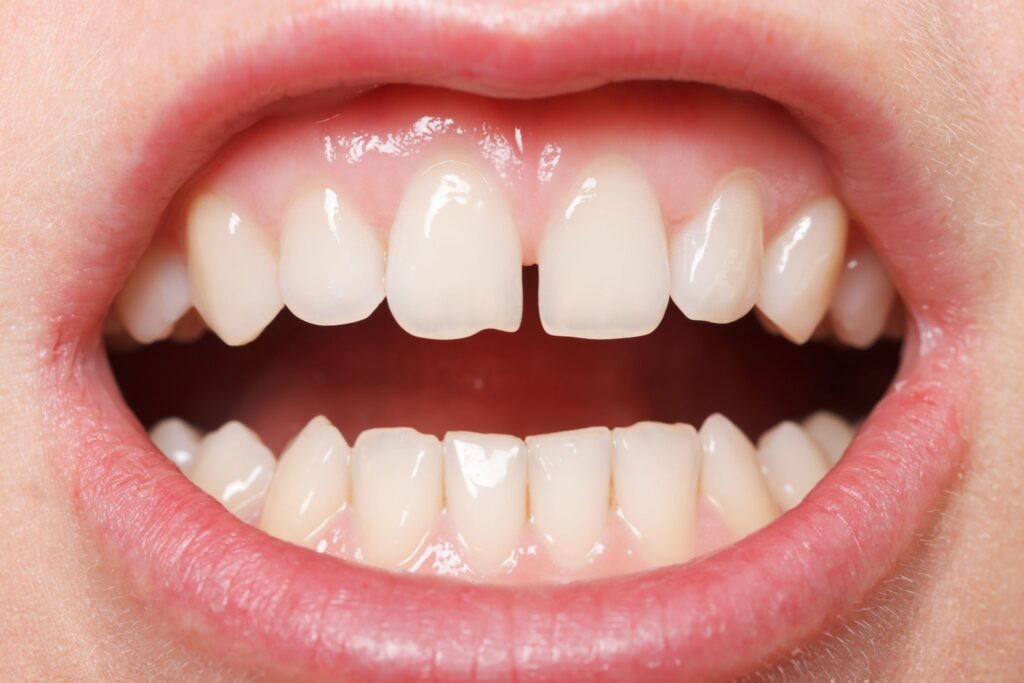 Causes of Chipped Teeth and How You Can Fix it
