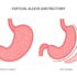 Gastric Sleeve Revision