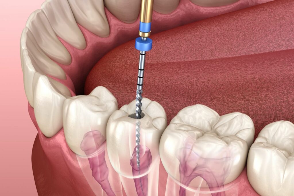FAQs about root canal therapy explained