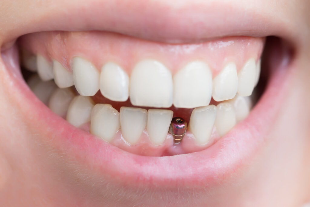 Top 6 Benefits of Getting Dental Implants