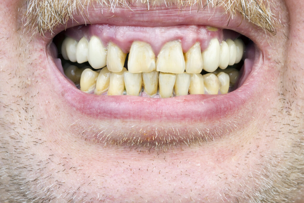 Most Common Signs & Symptoms of Periodontal Disease