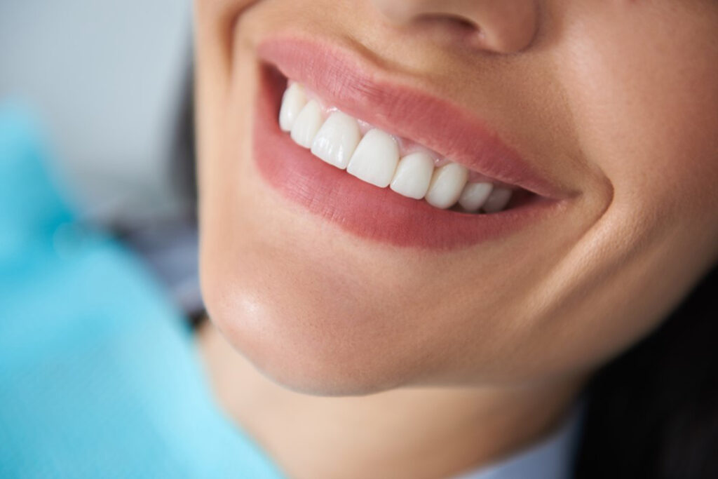 Your Guide To Dental Bonding