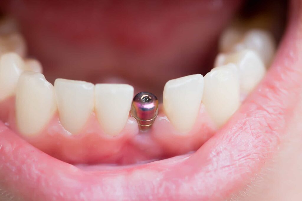 Top 6 Tips for Dental Implant Recovery