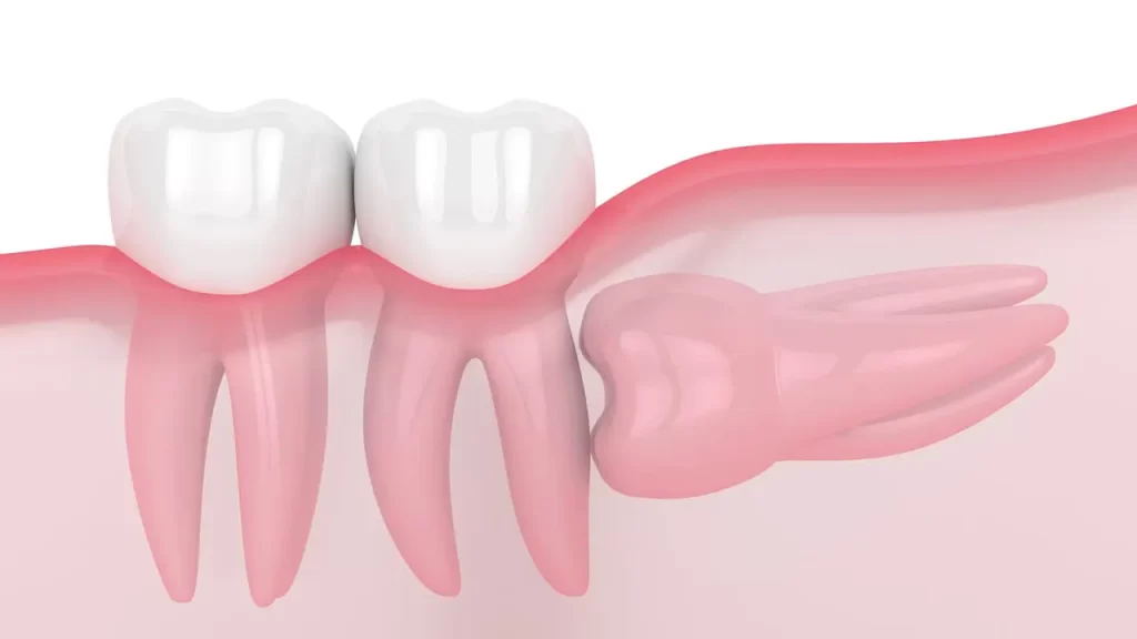 Five Problems Caused By An Impacted Wisdom Tooth