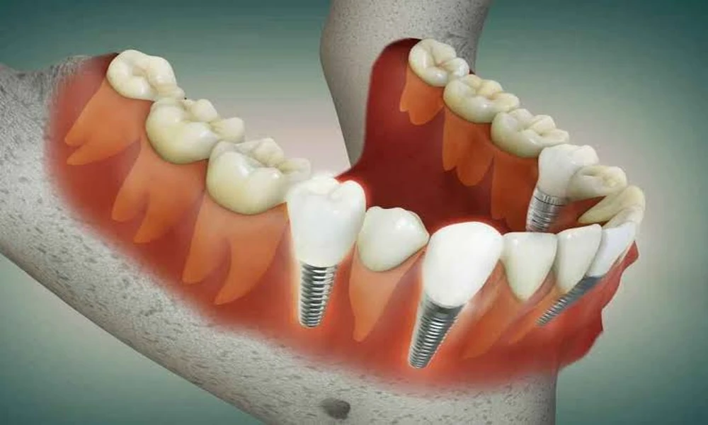 How Implant Dentistry Helps Prevent Bone Loss In The Jaw